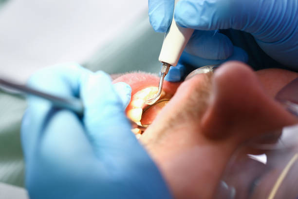 Best Emergency Dentist for Lost Fillings or Crowns in Queens Gate, PA